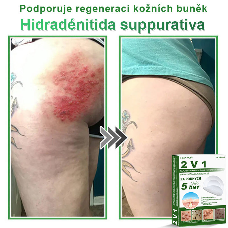 𝐇𝐮𝐝𝐫𝐨𝐬® 📌 𝟐𝐯𝟏 𝐡𝐲𝐝𝐫𝐨𝐤𝐨𝐥𝐨𝐢𝐝𝐧í 𝐧á𝐩𝐥𝐚𝐬𝐭𝐢 𝐬 𝐦𝐢𝐤𝐫𝐨𝐣𝐞𝐡𝐥𝐢č𝐤𝐚𝐦𝐢 | 𝐒𝐩𝐞𝐜𝐢á𝐥𝐧ě 𝐯𝐲𝐯𝐢𝐧𝐮𝐭é 𝐩𝐫𝐨 𝐨𝐝𝐬𝐭𝐫𝐚𝐧ě𝐧í 𝐯𝐲𝐬𝐭𝐨𝐮𝐩𝐥ý𝐜𝐡 𝐦𝐚𝐭𝐞ř𝐬𝐤ý𝐜𝐡 𝐳𝐧𝐚𝐦é𝐧𝐞𝐤, 𝐚𝐤𝐧é, 𝐩𝐥𝐨𝐜𝐡ý𝐜𝐡 𝐛𝐫𝐚𝐝𝐚𝐯𝐢𝐜 𝐚 𝐤𝐨ž𝐧í𝐜𝐡 𝐯ý𝐫ů𝐬𝐭𝐤ů | 𝐁𝐚𝐥𝐞𝐧í 𝟏𝟒𝟒 𝐤𝐮𝐬ů🌵🌵
