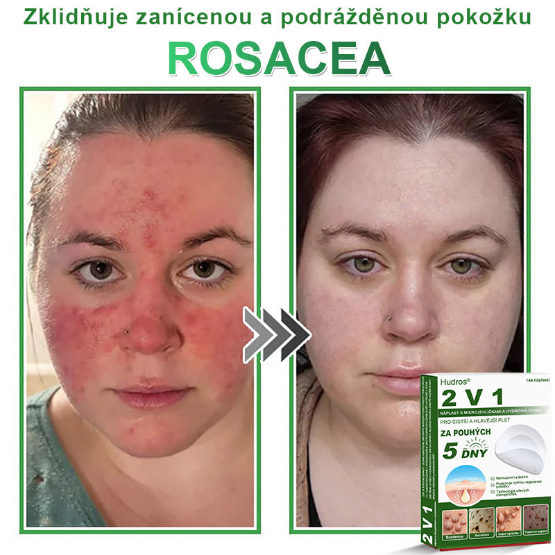 𝐇𝐮𝐝𝐫𝐨𝐬® 📌 𝟐𝐯𝟏 𝐡𝐲𝐝𝐫𝐨𝐤𝐨𝐥𝐨𝐢𝐝𝐧í 𝐧á𝐩𝐥𝐚𝐬𝐭𝐢 𝐬 𝐦𝐢𝐤𝐫𝐨𝐣𝐞𝐡𝐥𝐢č𝐤𝐚𝐦𝐢 | 𝐒𝐩𝐞𝐜𝐢á𝐥𝐧ě 𝐯𝐲𝐯𝐢𝐧𝐮𝐭é 𝐩𝐫𝐨 𝐨𝐝𝐬𝐭𝐫𝐚𝐧ě𝐧í 𝐯𝐲𝐬𝐭𝐨𝐮𝐩𝐥ý𝐜𝐡 𝐦𝐚𝐭𝐞ř𝐬𝐤ý𝐜𝐡 𝐳𝐧𝐚𝐦é𝐧𝐞𝐤, 𝐚𝐤𝐧é, 𝐩𝐥𝐨𝐜𝐡ý𝐜𝐡 𝐛𝐫𝐚𝐝𝐚𝐯𝐢𝐜 𝐚 𝐤𝐨ž𝐧í𝐜𝐡 𝐯ý𝐫ů𝐬𝐭𝐤ů | 𝐁𝐚𝐥𝐞𝐧í 𝟏𝟒𝟒 𝐤𝐮𝐬ů🌵🌵
