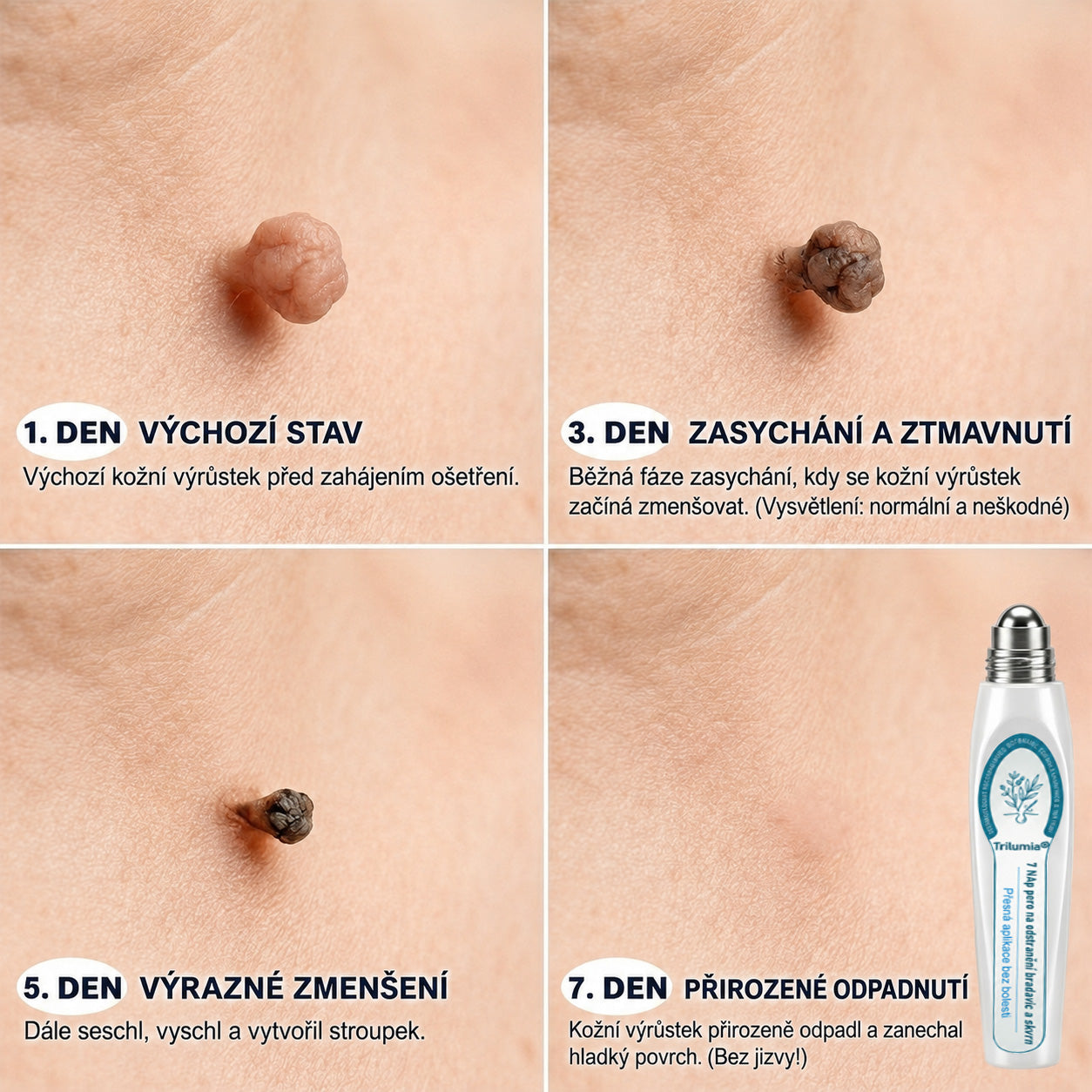𝐎𝐟𝐢𝐜𝐢á𝐥𝐧í 𝐨𝐛𝐜𝐡𝐨𝐝 𝐳𝐧𝐚č𝐤𝐲 | ✅️ 𝐓𝐫𝐢𝐥𝐮𝐦𝐢𝐚® 𝟕𝐝𝐞𝐧𝐧í 𝐩ří𝐩𝐫𝐚𝐯𝐞𝐤 𝐧𝐚 𝐨𝐝𝐬𝐭𝐫𝐚𝐧ě𝐧í 𝐤𝐨ž𝐧í𝐜𝐡 𝐯ý𝐫ů𝐬𝐭𝐤ů 𝐚 𝐩𝐢𝐠𝐦𝐞𝐧𝐭𝐨𝐯ý𝐜𝐡 𝐬𝐤𝐯𝐫𝐧 (𝐛𝐞𝐳𝐛𝐨𝐥𝐞𝐬𝐭𝐧ý 𝐫𝐨𝐥𝐥-𝐨𝐧 𝐚𝐩𝐥𝐢𝐤á𝐭𝐨𝐫 𝐛𝐞𝐳 𝐣𝐢𝐳𝐞𝐯)